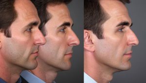 Redefining Beauty: Emerging Trends in Utah Plastic Surgery