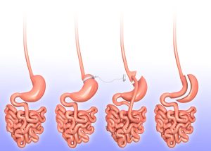 Understanding Gastric Sleeve Surgery: Key Insights into the Procedure and Its Benefits