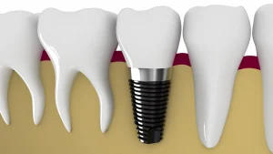 The Transformation of Dental Implants: How Modern Techniques are Changing Tooth Replacement in Australia