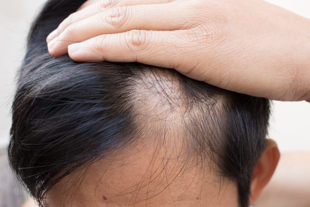 Living Confidently with Hair Patches: What to Expect