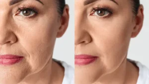 Smile Line Reduction: Effective Ways to Smooth Nasolabial Folds Naturally