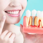 Transform Your Smile with All On 4 Dental Implants: A Comprehensive Guide