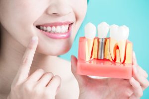 Transform Your Smile with All On 4 Dental Implants: A Comprehensive Guide