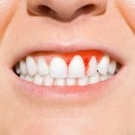 Why Are My Gums Receding? Symptoms You Should Know 2026