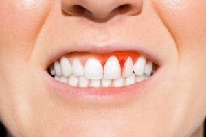 Why Are My Gums Receding? Symptoms You Should Know 2026