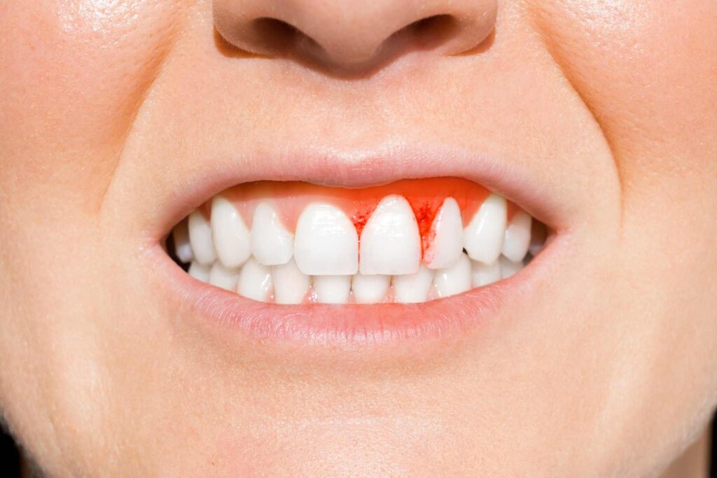 Why Are My Gums Receding? Symptoms You Should Know 2026