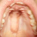 Why Does the Roof of My Mouth Hurt When I Swallow? Fix 2026