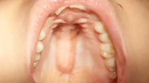 Why Does the Roof of My Mouth Hurt When I Swallow? Fix 2026