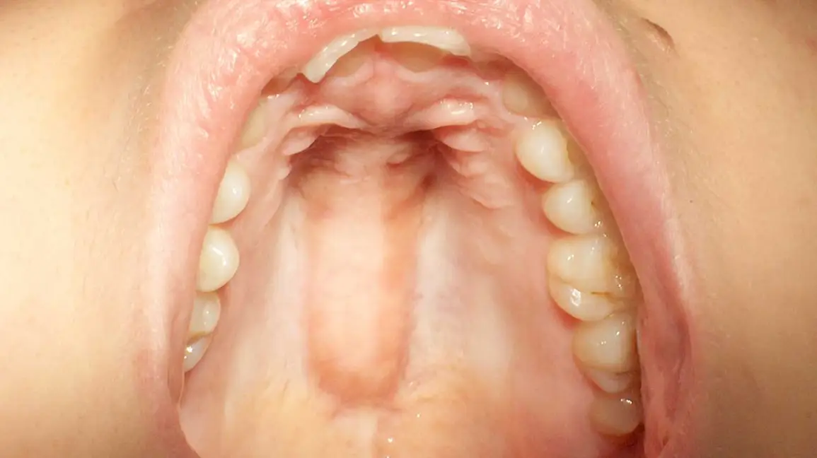 Why Does the Roof of My Mouth Hurt When I Swallow? Fix 2026