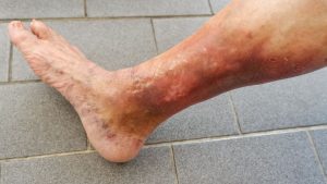 Why Do My Legs Feel Heavy? Here’s What It Means 2026