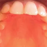 Why Is the Roof of My Mouth Sore When I Swallow? (2026 Guide)