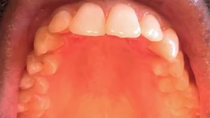 Why Does the Roof of My Mouth Hurt While Swallowing? 2026