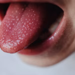 Why Is My Tongue Sore? Home Remedies That Help 2026