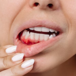 Why Are My Gums Bleeding? Warning Signs Explained 2026