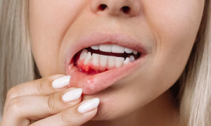 Why Are My Gums Bleeding? Warning Signs Explained 2026