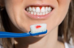 Why Do My Gums Bleed When I Brush My Teeth? Fixes 2026