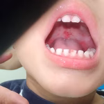 Why Does the Roof of My Mouth Hurt When I Eat? 2026