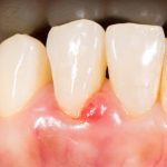 Why Is My Gum Swollen Around One Tooth in the Back Suddenly? 2026
