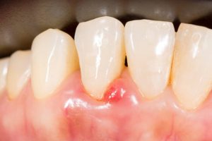 Why Is My Gum Swollen Around One Tooth in the Back Suddenly? 2026