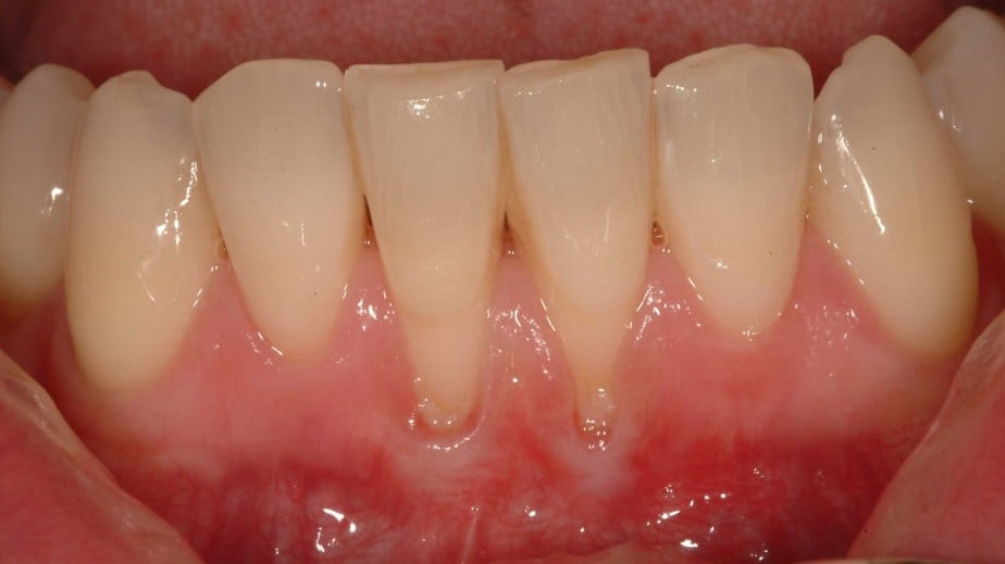 Why Are My Gums Receding? Symptoms You Should Know 2026