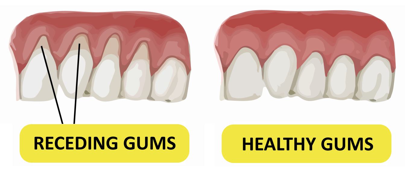 Why Are My Gums Receding? Symptoms You Should Know 2026