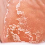 Why Are My Feet Peeling? Is It a Fungal Infection? 2026