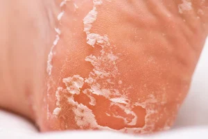 Why Are My Feet Peeling? Is It a Fungal Infection? 2026