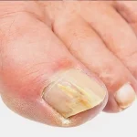 Why Are My Toenails Yellow? When to See a Doctor 2026