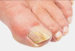 Why Are My Toenails Yellow? When to See a Doctor 2026