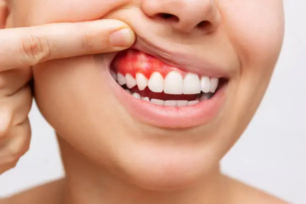 Why Is My Gum Swollen Around One Tooth in the Back Suddenly? 2026