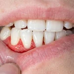 Why Is My Gum Swollen Around One Tooth? Dentist Advice 2026