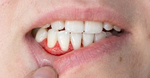 Why Is My Gum Swollen Around One Tooth? Dentist Advice 2026