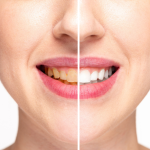 Why Are My Teeth Yellow When I Brush Them Everyday? Causes 2026