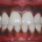 Why Are My Gums Black? Smoking and Other Causes 2026