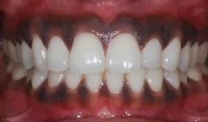 Why Are My Gums Black? Smoking and Other Causes 2026