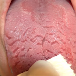 Why Does My Tongue Have Cracks? Health Warning Signs 2026