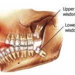 Why Are They Called Wisdom Teeth? The History Behind It 2026