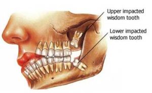 Why Are They Called Wisdom Teeth? The History Behind It 2026