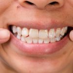 Why Do I Have White Spots on My Teeth? Should You Worry? 2026