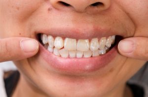 Why Do I Have White Spots on My Teeth? Should You Worry? 2026