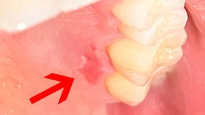 Why Does the Top of My Mouth Hurt? What It Means 2026