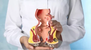 Why Do Hemorrhoids Bleed? Signs You Shouldn’t Ignore 2026