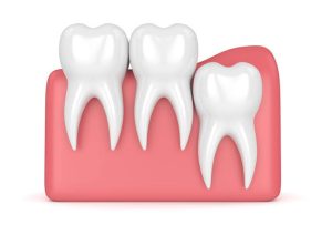 Why Are Wisdom Teeth Called Wisdom Teeth? Dental Meaning 2026