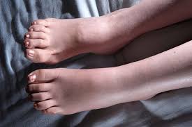 Why Do My Ankles Swell? When Should I Worry? 2026