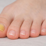 Why Is My Toenail Yellow? When to See a Doctor 2026