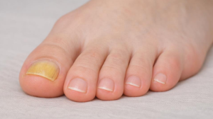 Why Is My Toenail Yellow? When to See a Doctor 2026
