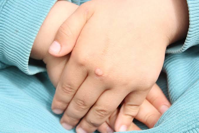 Why Do Kids Get Warts? Causes, Risks & Remedies 2026