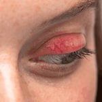 Why Are My Eyelids Red? Allergies or Infection? (2026)