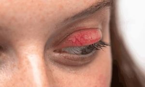 Why Are My Eyelids Red? Allergies or Infection? (2026)