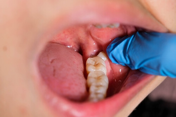 Why Is It Called Wisdom Teeth? The Origin Explained 2026